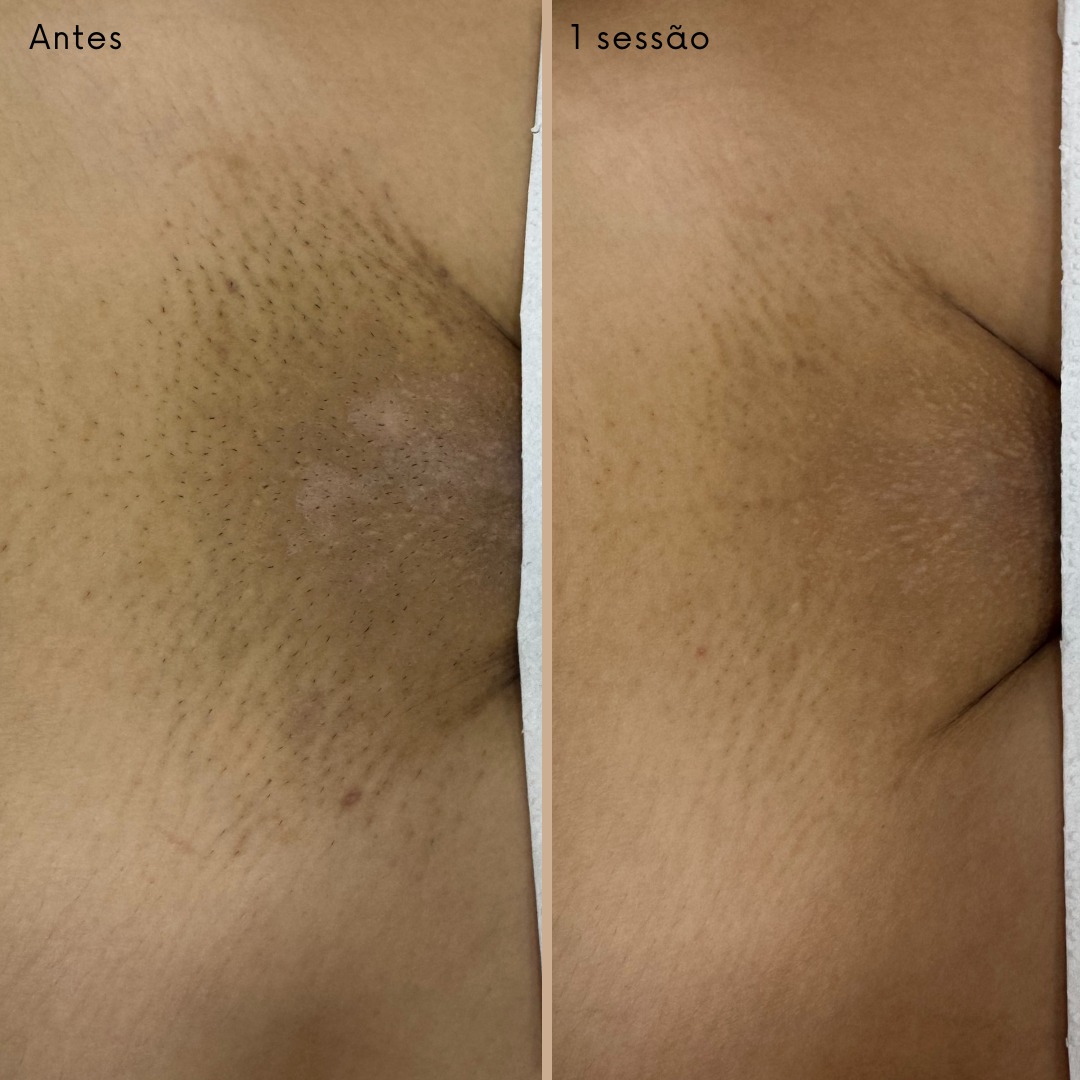 Antes e depois 1