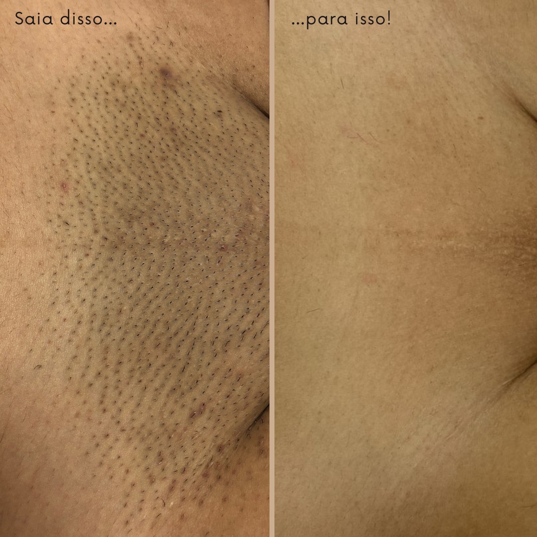 Antes e depois 2