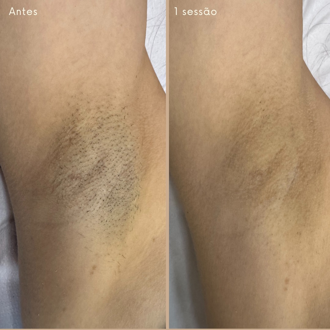 Antes e depois 7
